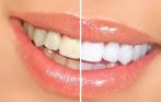 Отбеливание зубов Amazing White со скидкой 80% и комплексный метод профессиональной гигиены полости рта (ультразвук и Air Flow) в подарок, а также более 50% скидки на другие услуги в клинике стоматологии и имплантации «Ювелирная работа»