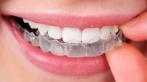 Установка брекет-систем в клиниках «Добрый доктор» со скидкой до 73%